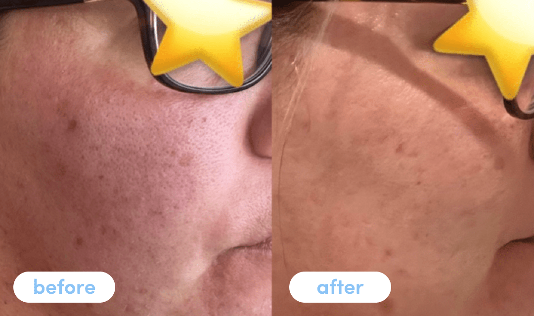 J. W - Taking Premium Collagen Peptides for 6 weeks