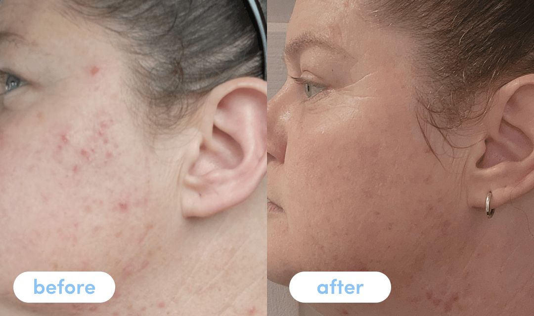 Linda K. has been taking Premium Collagen for 6 weeks