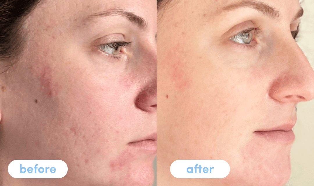 Nare P. - Taking Premium Collagen Peptides for 4 weeks