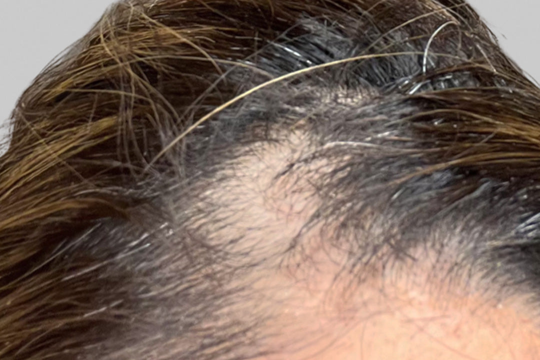 Close-up of thinning hair on a scalp, showing a sparse patch and strands. Ideal for beauty or hair growth supplement discussions.