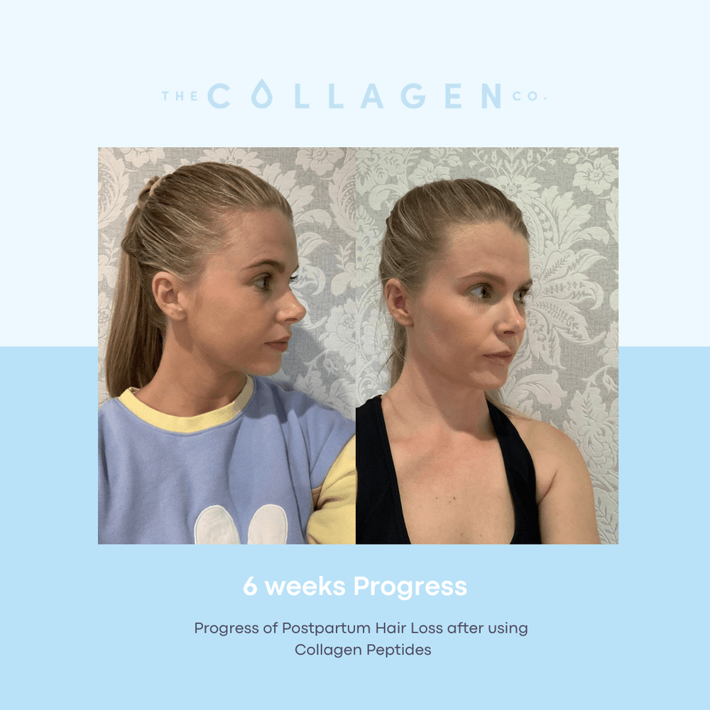 Becky Getting Through Postpartum Hair Loss By Taking Collagen