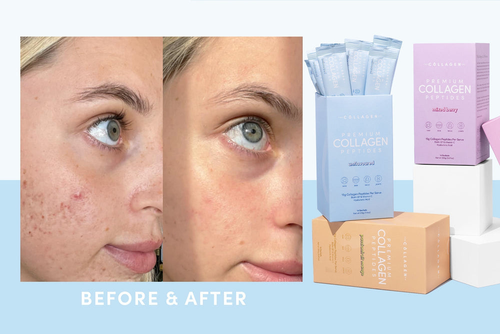 Does Collagen Help Acne Scars?