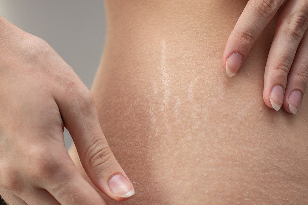 Does Collagen Reduce Stretch Marks?