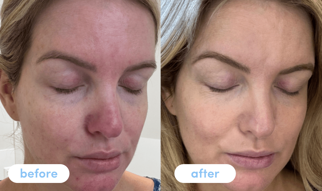 Hayley S - Taking Premium Collagen for 4 weeks