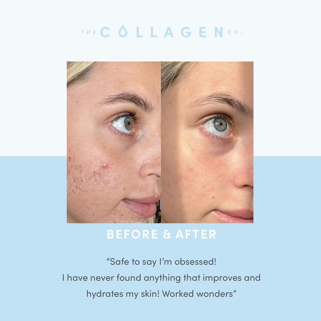How Bonnie Tackled Mild Acne - The Collagen Co.