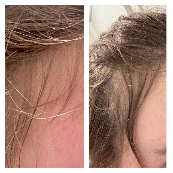 Side-by-side close-up photos of a persons hairline, showing thinning hair on the left and thicker regrowth on the right, indicating a visible improvement in hair density.