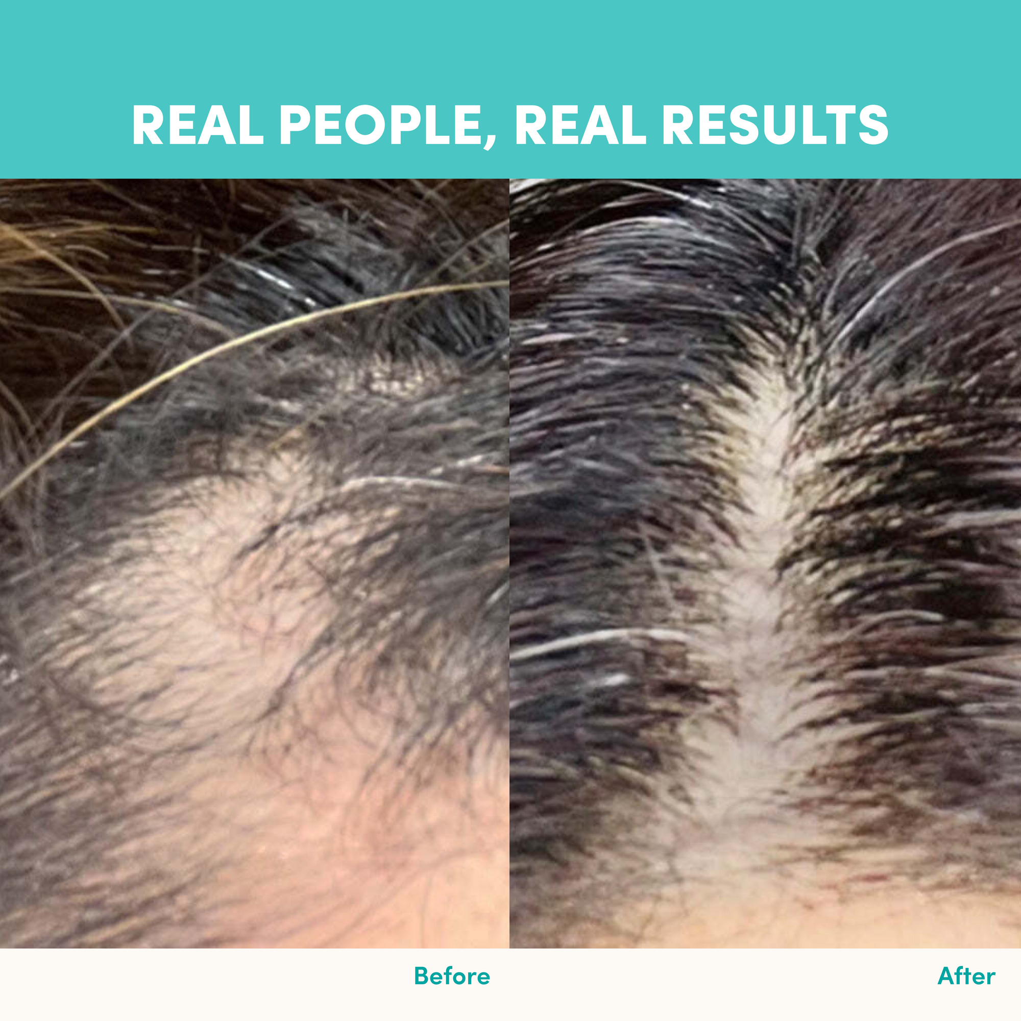 Close-up comparison of a person's scalp before and after using The Collagen Co. Unflavored Beauty Marine Collagen Powder - 284g, showing increased hair density and reduced thinning. Text above reads Real People, Real Results.