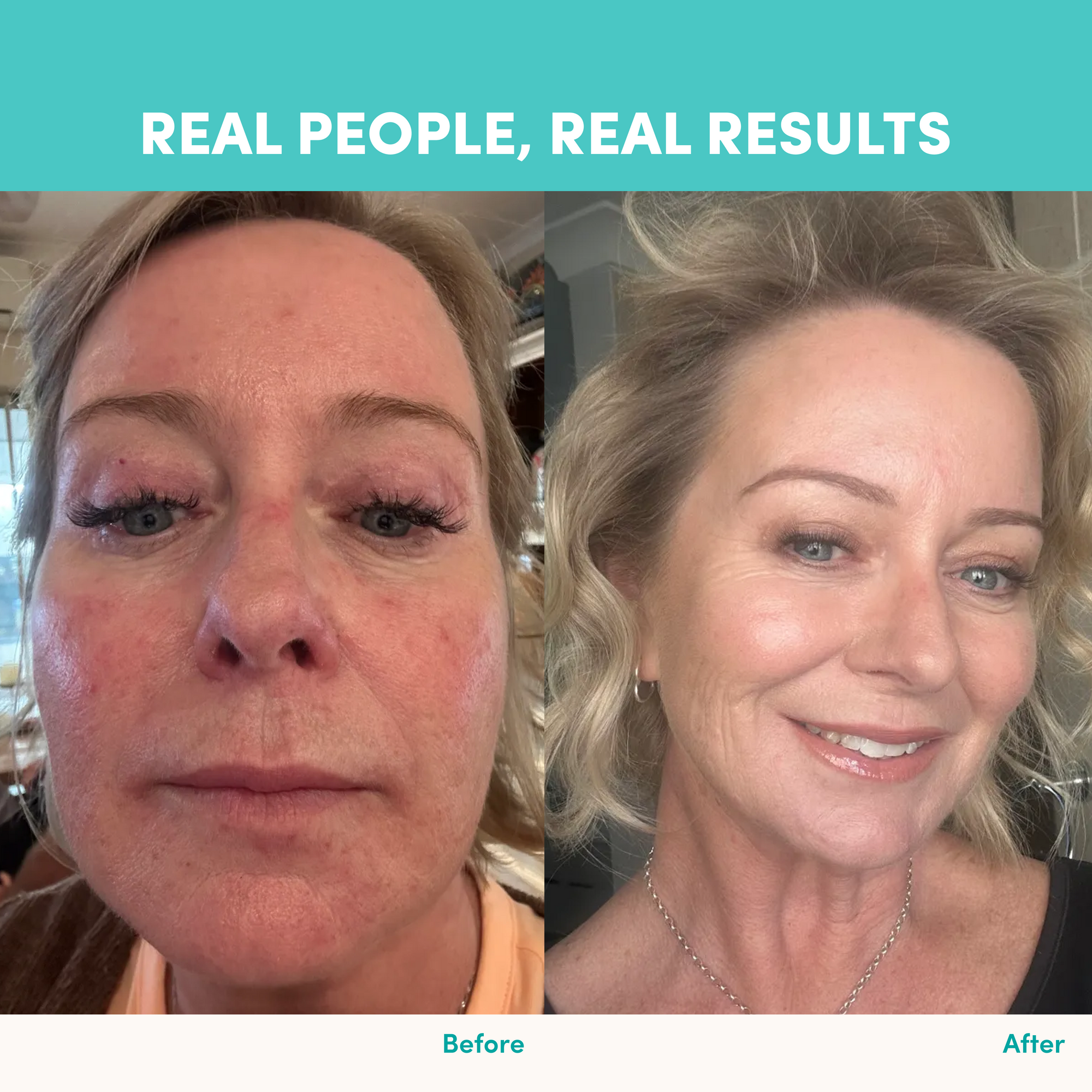 Side-by-side photos of a woman before and after using The Collagen Co. Unflavored Beauty Marine Collagen Powder (284g). Left: redness and uneven skin; right: smoother, clearer skin. Text reads: REAL PEOPLE, REAL RESULTS.