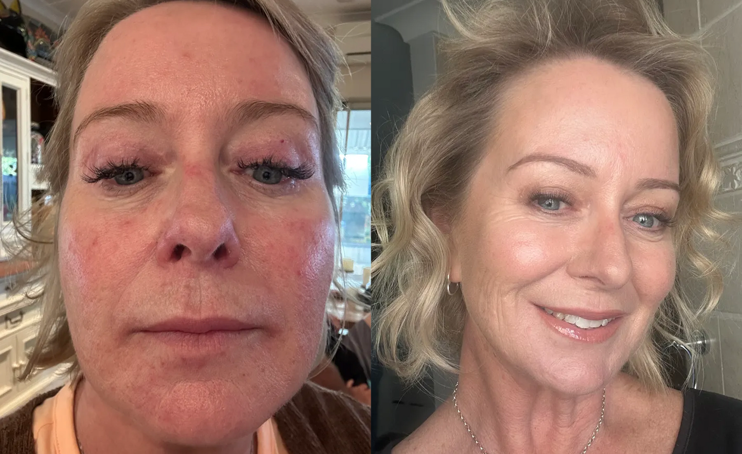 Side-by-side photos of a woman: on the left, her face appears red and irritated; on the right, her complexion is clear and smooth, and she is smiling.