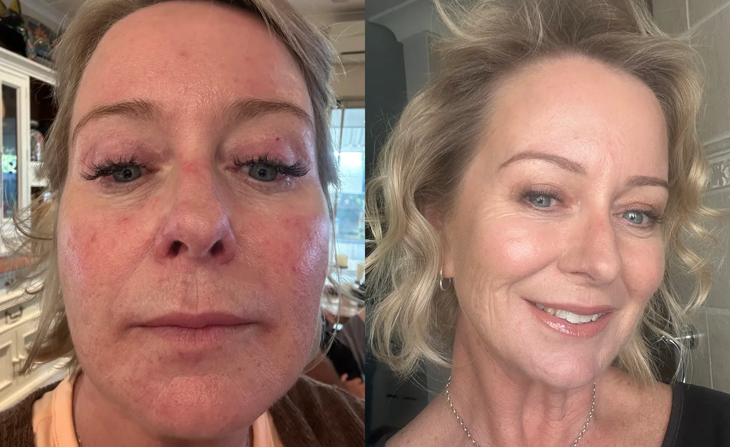 Side-by-side photos of a woman; on the left, her face appears red and irritated, while on the right, her skin looks smooth and clear, and she is smiling.