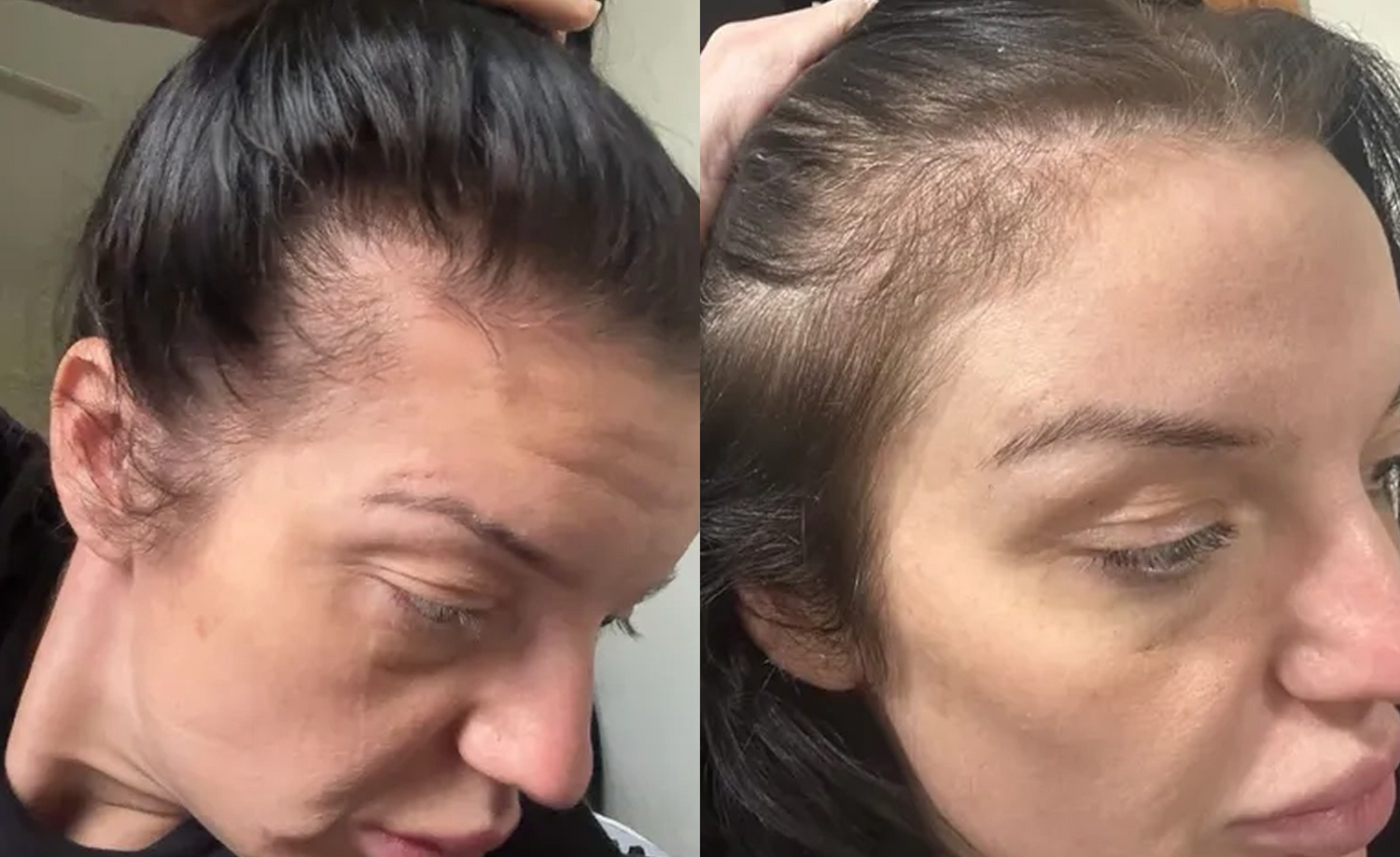 Side-by-side close-up photos of a woman’s head showing hair thinning and receding hairline on both sides near her forehead, as she pulls back her dark hair to reveal her scalp.