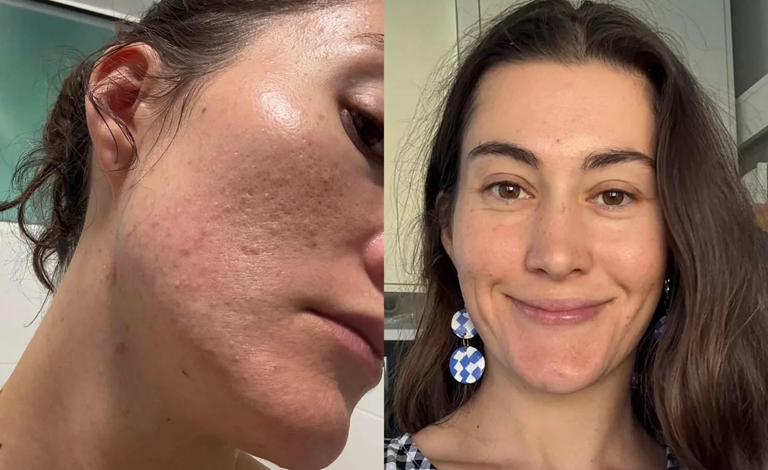 Side-by-side comparison of a woman’s face; left shows close-up of acne scars and textured skin, right shows her smiling with clearer, smoother skin and wearing blue earrings.