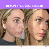 Side-by-side photos show a woman’s face before and after using thecollagen.co Purple Grape Collagen Powder (560g), with visible acne and redness reduced to smoother skin, under the heading “Real People, Real Results.”.