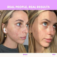 Side-by-side photos of a woman’s face before and after using The Collagen Co. Mixed Berry Collagen Sachets; the left shows acne and redness, the right reveals smoother, clearer skin. Text: “REAL PEOPLE, REAL RESULTS.”.