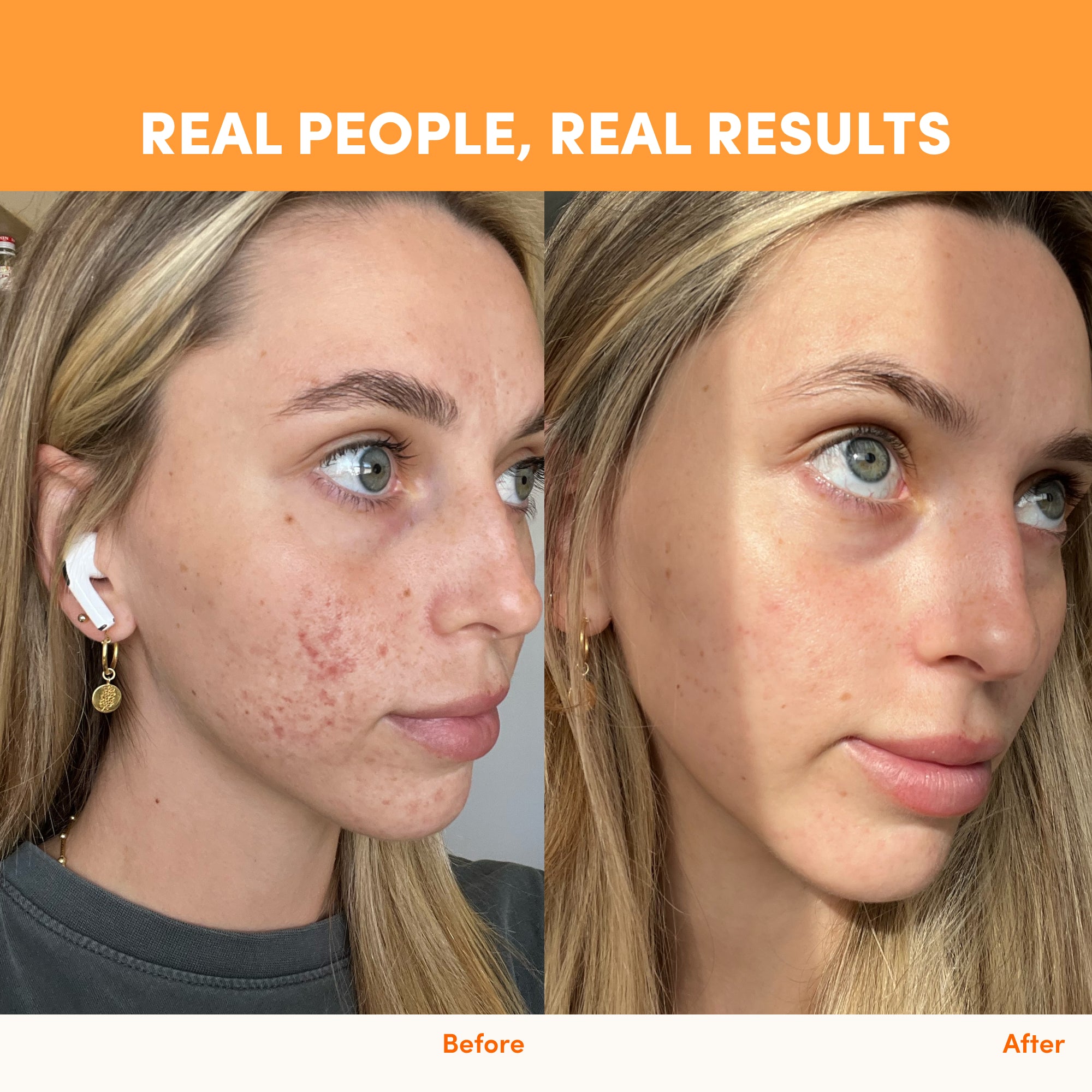 Side-by-side images show a woman’s skin before and after using thecollagen.co Passionfruit Mango Collagen Sachets - 280g, with clearer results on the right. Text: “Real People, Real Results.” Elevate your beauty journey with collagen!.