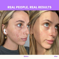 Side-by-side photos of a blonde woman show her skin transformation using The Collagen Co USA Purple Grape Collagen Sachets—left with acne/redness, right with smoother, clearer skin. Text: “REAL PEOPLE, REAL RESULTS,” labeled “Before” and “After.”.