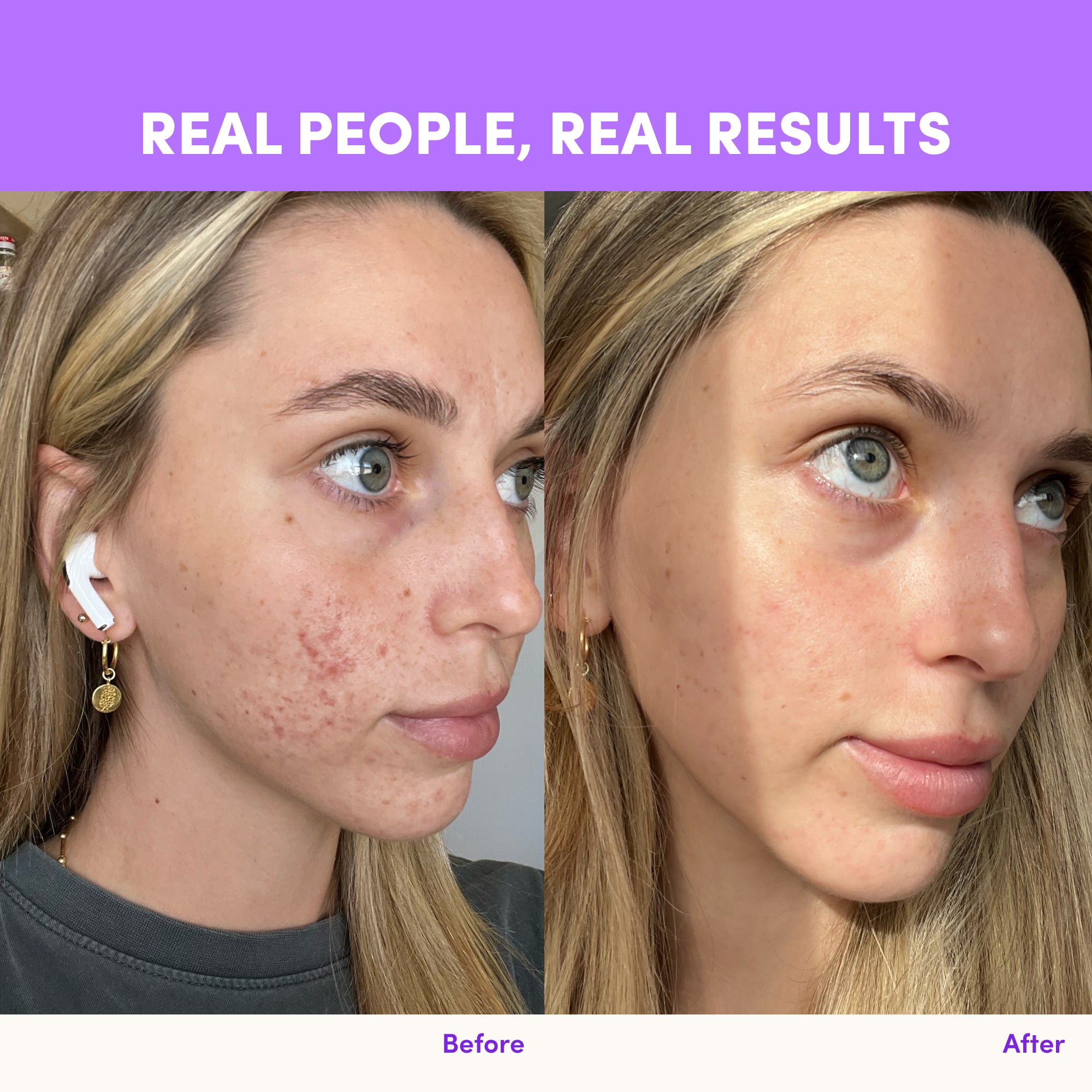 Side-by-side photos of a blonde woman show her skin transformation using The Collagen Co USA Purple Grape Collagen Sachets—left with acne/redness, right with smoother, clearer skin. Text: “REAL PEOPLE, REAL RESULTS,” labeled “Before” and “After.”.