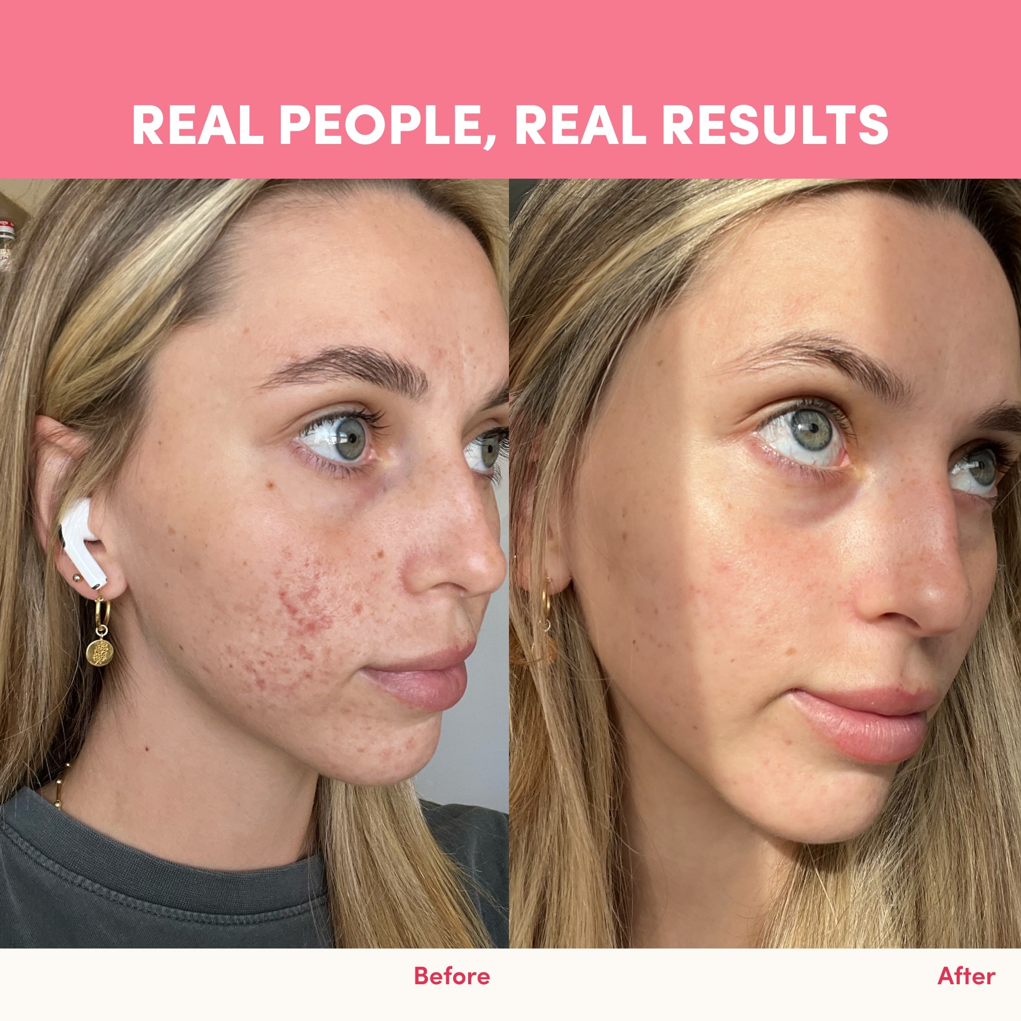 Side-by-side photos show a woman’s face before and after using The Collagen Co. Love Your Glow Bundle, with reduced redness and acne scars. Text above reads: “REAL PEOPLE, REAL RESULTS.”.