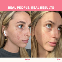 Side-by-side photos show a woman’s face before and after using The Collagen Co. Gut Feelings Beauty Bundle; the left shows acne and redness, while the right is clearer—highlighting how real people see real results.