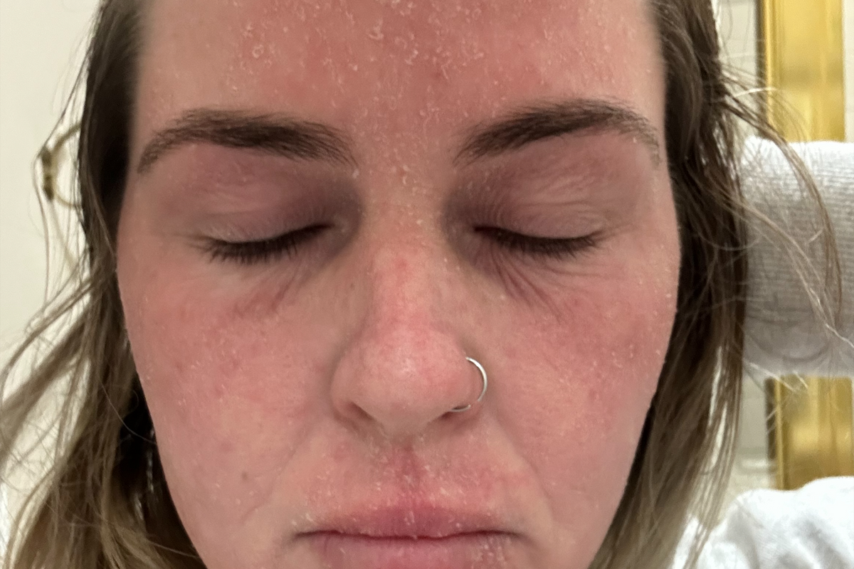 Before and after using peptides and collagen