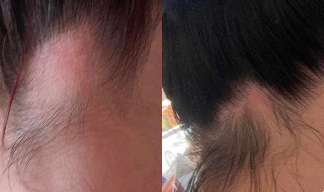 Close-up comparison of two hairlines, both showing redness and thinning hair near the temple area, possibly indicating irritation or early hair loss.