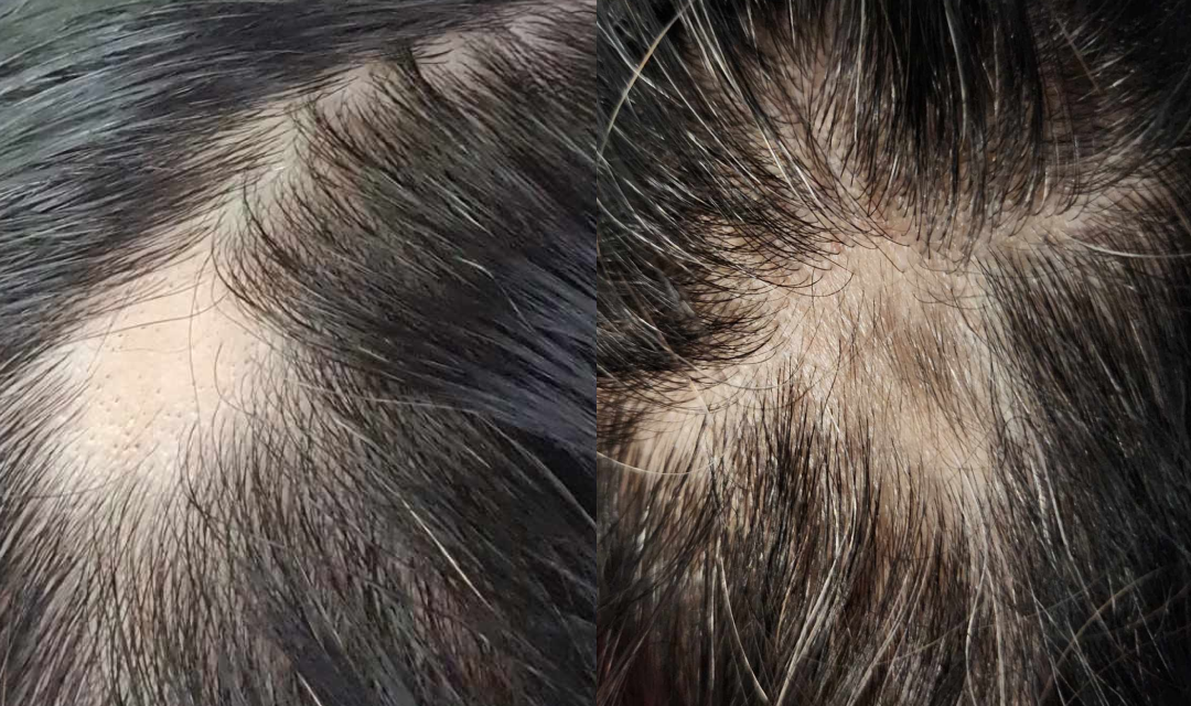 Close-up photos of a persons scalp showing two areas of thinning hair and visible bald patches, highlighting hair loss and sparse hair coverage.