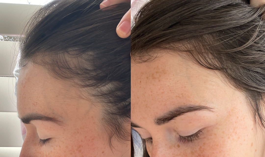 Side-by-side close-up photos of a person’s hairline and temple. The left image shows thinning hair, while the right image shows fuller hair growth in the same area. The person’s eyes are closed in both images.