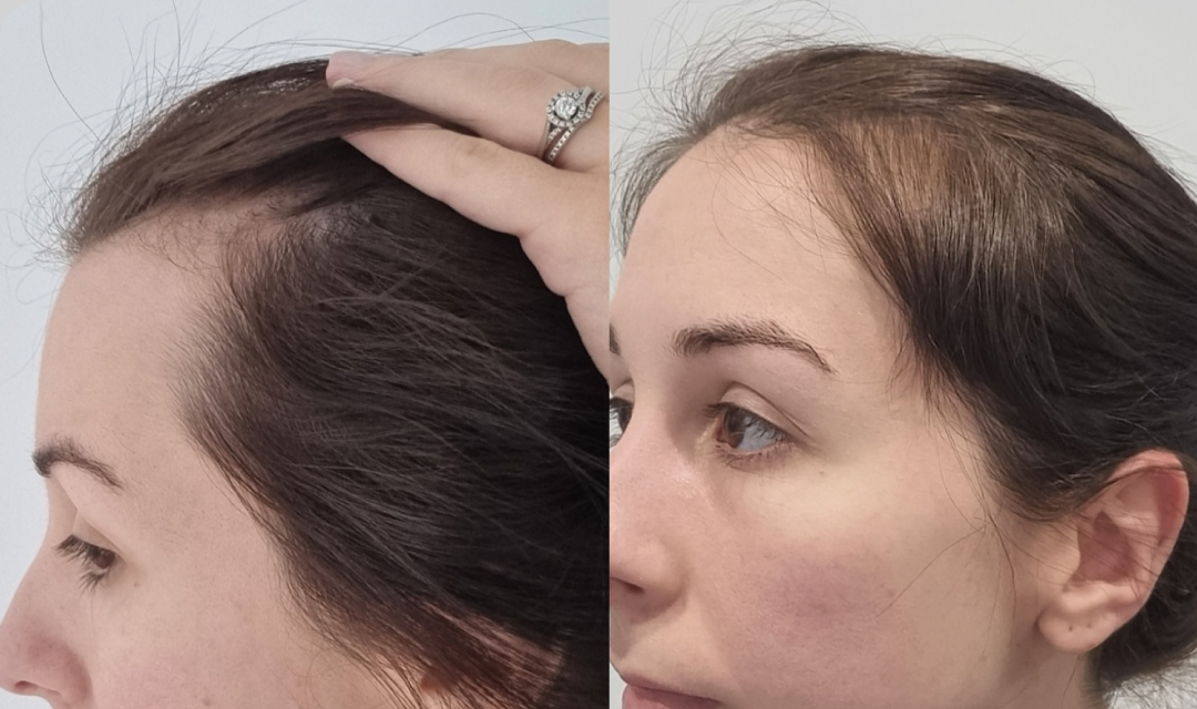 Side-by-side close-up photos of a womans head showing hair loss along the hairline on the left and fuller hair growth along the same area on the right. She is facing left in the left photo and right in the right photo.